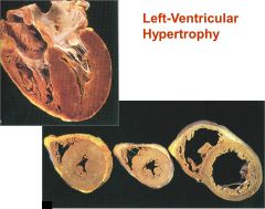 LVH w/o dilation (far L heart) is typical in pt w _____________


 


(middle is normal & R is LVH + dilation)