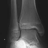 fracture and treatment