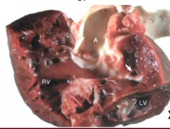 1.*Hypoplasia and malpositioning of the conotruncal septum
2. Overriding (dextroposition) of aorta (covers the VSD)
3. High VSD
4. Pulmonic stenosis 
5. Hypertrophy of right ventricle is secondary defect