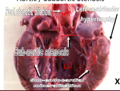 A malformation of the aortic valve leads to increased afterload and left ventricular hypertrophy

Myocardial necrosis is also seen due to ventricular dysrhythmias 