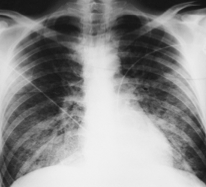 Bilaterale lungeinfiltrater, særlig perihilært og basalt, men uten forstørret hjerte eller karstuvning. 
TRALI er vanligste transfusjonsrelaterte dødsårsak.
