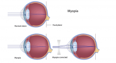 1. Myopia
2. Eyeball too long in relation to the lens - images focus in front of the retina
3. Convex lens