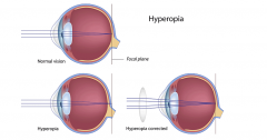 1. Hyperopia
2. Eyeball too short in relation to the lens - images focus behind the retina.
3. Concave lens