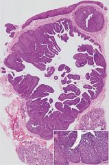 Papillary intraductal proliferation located beneath the mucosal surface