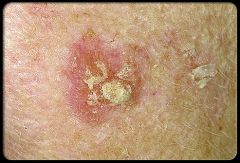 Scaly pink macules
Cause: sun exposure
premalignant -> Squamous Cell Carcinoma
always biopsy 
Treat: 5-fluorouracil cream