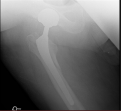 Vancouver B2 peri-prosthetic fracture with loose femoral stem. In Vancouver B2 periprosthetic femur fx it is recommended that the fx be stabilized with the use of an uncemented extensively porous coated fem component. However, in order to increase...