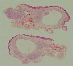 No epithelial lining


Granulation tissue lines the central space


 