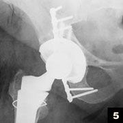 A periprosthetic acetabular fx is noted intra-op during THA. The acetabular component is stable and well-fixed after implantation of an ingrowth acetabular shell. Which of the following treatment options will best maintain motion and clinical func...