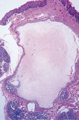 No epithelial lining


Granulation tissue lines the central spac
