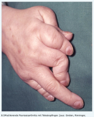 - 10% Mutilierende Psoriasisarthritis mit Teleskopfinger (Finger lassen sich der Länge nach teleskopartig ausziehen)