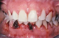 oral ulcers


susceptible to infections