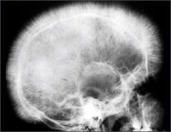Hair-on-end skull radiograph