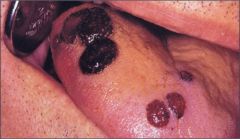 increased brusing


Petechiae and ecchymosis

  Hematoma

  Gingival hemorrhag


Fibrin deposits