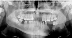 bone and tooth loss that does not make sense