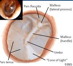 Part of tympanic membrane where most tears occur