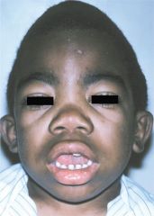Hunter syndrome exhibits the characteristic facial features of this disorder


 