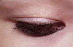 Thickened papules are present along margin of the eyelid


 