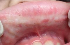 mucosa nodular, diffusely enlarged & thickened 
