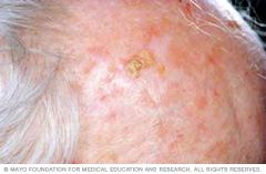 - Sun exposed areas 
- Small, rough, scaly lesions d/t prolonged sun exposure
- Common in fair skinned people, typically on face


biopsy to exclude squamous cell carcinoma 


tx: 5-FU topical, 5% imiquimod cream, topical diclofenac gel or photody...
