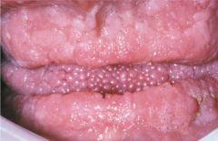 Multiple, irregular fibroepithelial papules involve the tongue and alveolar ridge mucos


 