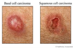 - Less common than SCC
- Risks: sun exposure, actinic keratoses, chronic skin damage, immunosuppressive therapy 


PE: crusting, ulcerated nodule or erosion, red conical hard lesions


*Metastasis is higher than BCC, lower than melanoma
*90% cause...