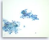 Pancreatic cyst FNA with flat PAS+ epithelial cells.


 


- Diagnosis?