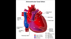 AKA endocardial cushion defect

deficiency of the atrioventricular septum of the heart. It is caused by an abnormal or inadequate fusion of the superior and inferior endocardial cushions with the mid portion of the atrial septum and the muscular...
