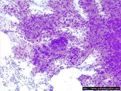 LN FNA


Affects children


Self-limited process


 


Diagnosis?
