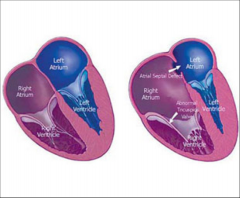 Right Atrial Enlargement***
Apical Displacement of tricuspid valve***
sits lower in heart than normal
Normal = 1-2mm lower than mitral valve