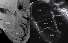 Apical displacement of septal and posterior tricuspid valve leaflets
Valve leaflet lowered into right ventricle
Results in atrialization of RV

- congenital heart defect in which the septal leaflet of the tricuspid valve is displaced towards t...