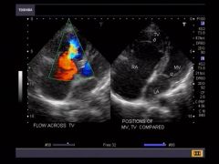 Cardiomegaly
Right atria large while right ventricle small from atrialization – only a small amount of functional right ventricle left
Pulmonary artery often from lack of flow
Color Doppler to eval regurg through tricuspid valve