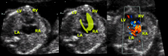 Dilated and often wraps under left ventricle apex
Hypertrophied with good function