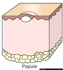 This is a papule, <1cm solid elevation of the skin. usually a hyperplastic process due to inflammatory infiltrates 
(insect bite, papilloma, superficial folliculitis)