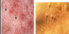 What term is used to diagnose these bumps on the skin?