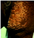 What term is used to describe these lesions?