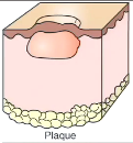 These are plaques, flat, slightly elevated solid large lesions that are "plateau-like" 

From coalescing papules or from eosinophils