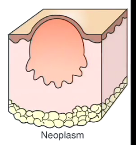 These are neoplasms, abnormal masses of tissues that exceed and is uncoordinated with that of normal tissue. 
