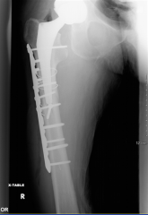 Vancouver B1 periprosthetic femur fracture. The stem appears stable within the femur, and there is no evidence of subsidence with comparison to the initial post-THA radiographs. This fracture pattern is best treated with internal fixation.  Peripr...