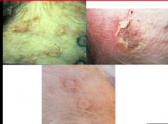What are these lesions called?