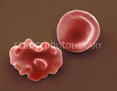 On the right is a healthy red blood cell. The cell on the right is also a blood cell but it is not so healthy.
Why is that?
A It has contracted a disease
B It is mutated
C It has been subjected to a hypertonic environment
D It has been subjec...