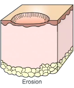 These are erosions, superficial defects of the epidermis
*basement membrane and dermis is in tact

Surface trauma or from a prior vesicle/pustule rupture