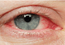 Conjunctivitis is inflammation of conjuctiva (thin clear tissue laying over white part of eye and also lines the lid). Can be infectious or non-infectious in nature. 


Infectious: viral (most common) or bacteria (in kids, very contagious)


...