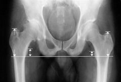 What percentage of patients with complete peroneal nerve palsy after total hip arthroplasty will never recover full strength?  1-90% to 95%; 2-60% to 65%; 3-40% to 45%; 4-20% to 25%; 5-0% to 5%