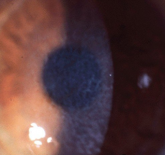 what corneal dystrophy is this?