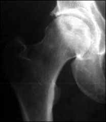 In pts with SCD and asymptomatic ON of the femoral head identified with MRI, what % will eventually go on to femoral head collapse?  1.  < 10%; 2.  11% to 25%; 3.  26 to 50%; 4.  51 to 75%; 5.  > 75%