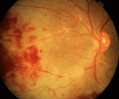 A patient with AIDS presents with symptoms of visual loss, floaters and photopsia (perceived flashes of light). Eye exam showed fluffy yellow-white lesions close to vessels with hemorrhage. What is the diagnosis and treatment?