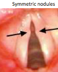  - Pathogenesis:
Reaction to injury of vocal cord






- Classic location at junction
anterior and middle third of cord
- 










Occurs following sustained
injury caused
by

  Heavy smoking

  Heavy, recurrent voi...
