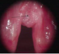 - Papillomas: Benign
neoplasms located
on true vocal cords 






- Usually
single
in adults, but can be recurrent 
- Multiple in children  (juvenile laryngeal papillomatosis)






- Caused
by HPV
types 6/11





