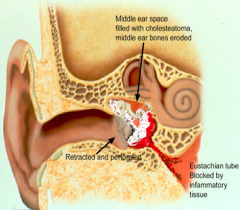 










Squamous epithelium
trapped
within the
temporal bone
(middle ear
or mastoid) 





