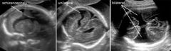 Absent CSP 70% (nearly 100% when bilateral)
If cleft is visible: wedge shaped CSP filled defect through brain parenchyma 
Apex points towards lateral ventricle
Face, profile normal
Calcifications seen within interior walls of lateral ventricle...